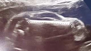 Sonogram shows WHAT [upl. by Alle665]