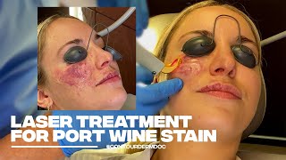 Treating a PortWine Stain with Excel V Laser at Contour Dermatology [upl. by Ahsert]