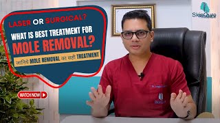 What is the Best Treatment for Mole Removal  Mole removal in Delhi  Mole removal by Laser [upl. by Campman]