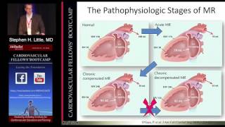 Mitral Regurgitation Stephen H Little MD Sunday August 21 2016 [upl. by Margreta]