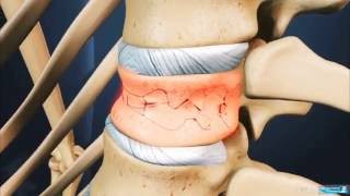 Sakit Punggung Ankylosing Spondylitis  Dr Eko Agus Subagio Sp BS  Spine [upl. by Akiraa777]