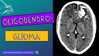 Oligodendroglioma [upl. by Amir]