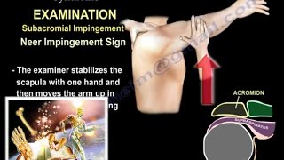 Shoulder Impingement Syndrome  Everything You Need To Know  Dr Nabil Ebraheim [upl. by Sheelagh]