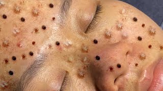 Blackheads amp Acne Treatment 01052024 Part 7 [upl. by Gass82]