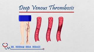 DVT Deep Venous Thrombosis Pathophysiology  Risk Factors  Presentation  Diagnosis  Management [upl. by Reddin]