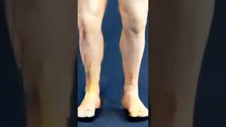 Knee HyperextensionEhicordfilm [upl. by Aicilet]