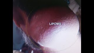 LIPOMA NECK [upl. by Gretal]