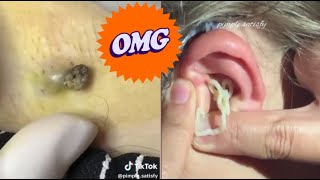 Blackhead Popping Extravaganza Satisfying Skin Care Moments [upl. by Thomasin]