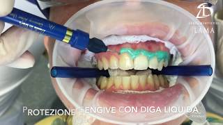 Studi Dentistici Lama  Sbiancamento Dentale alla Poltrona [upl. by Enitsrik]