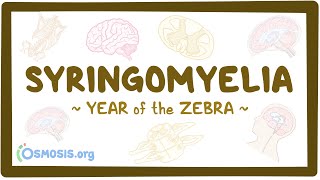 Syringomyelia Year of the Zebra [upl. by Yazbak45]