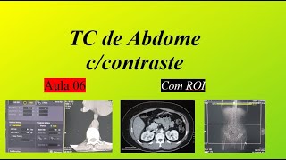 Curso de Tomografia ccontraste  Aula 6 Abdome Trifásico c ROI [upl. by Chariot581]