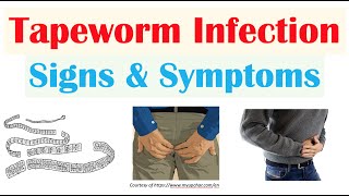 Tapeworm Infection Signs amp Symptoms Nutrient Deficiencies amp Complications [upl. by Colb]