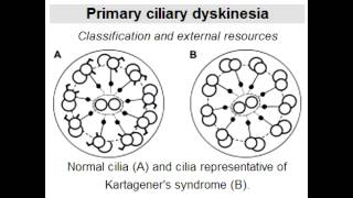 Kartageners Syndrome dynein arm defect affecting cilia [upl. by Enileqcaj]