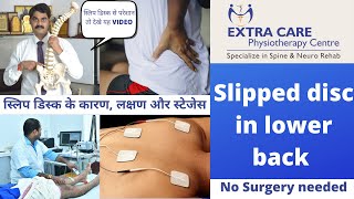 Slipped Disc in Lower Back  स्लिप डिस्क के कारण लक्षण और स्टेजेस [upl. by Nolak]