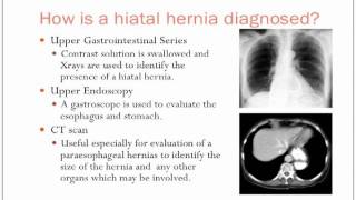 Hiatal Hernias [upl. by Ecnarret524]