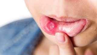 6 Ways How To Cure Mouth Ulcer Permanently In One Day [upl. by Goer]