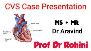 CVS Case Presentation  Mitral stenosis with Mitral Regurgitation  Dr Aravind amp Prof Dr Rohini [upl. by Artied]