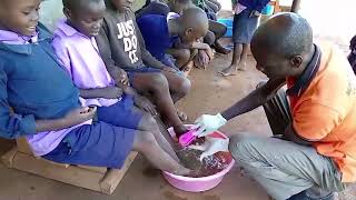 Anti jigger campaign MUSA PRIMARY SCHOOL a kid with scabies treated [upl. by Gromme]