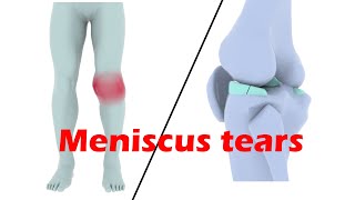 Meniscus tear explained in 3D animation [upl. by Ayotaj806]