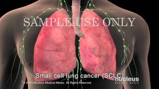 Small Cell Lung Cancer Staging [upl. by Ellissa]