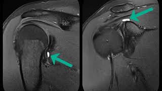 Shoulder MRI SLAP Type 3 Labral Tear 360 Degree Labral Tear [upl. by Kristofor]