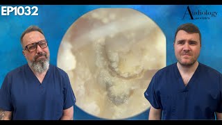 Removing a FUNGAL INFECTION from someones EAR CANAL  EP1032 [upl. by Reece]