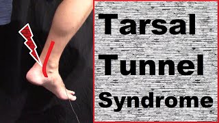 Understanding amp Treating Tarsal Tunnel Syndrome [upl. by Missie]