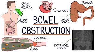 Understanding Bowel Obstruction [upl. by Nerret]