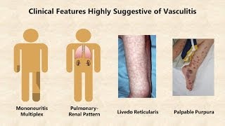 Vasculitis  An Overview [upl. by Llenreb]