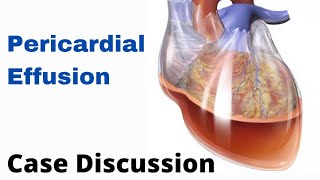 Case Discussion  Pericardial Effusion [upl. by Persian]