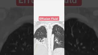 Effusion Fluid [upl. by Eward]