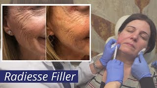 Radiesse Filler Calcium Hydroxylapatite CaHA Injections [upl. by Issac529]