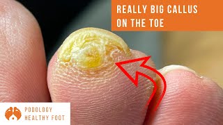 REALLY BIG CALLUS ON THE TOE  Removal  PodiatryMetatarsalPodiatristPodologiaFeetASMR podiatry [upl. by Nomi]