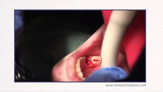 Ankylosis of Primary Tooth  The Tooth Station [upl. by Nyltiak933]