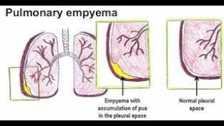 Pleural Empyema  empyema  causes symptoms treatment  empyema medicine lecture  empyema [upl. by Ahsocin]