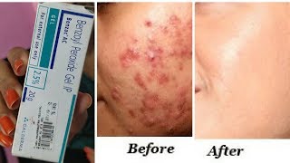 इससे होंगे पिंपल्स खत्म  Clear Acne Pimples once and for all  best solution for acne RabiaSkincare [upl. by Joung]