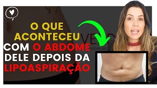 Tratamento para Fibroses após Lipoaspiração o que aconteceu com o abdome dele [upl. by Harty]