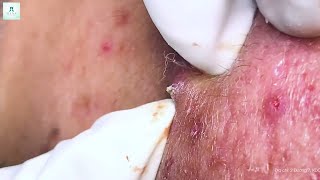 Big Cystic Acne Blackheads Extraction Blackheads amp Milia Whiteheads Removal Pimple Popping [upl. by Vastha]