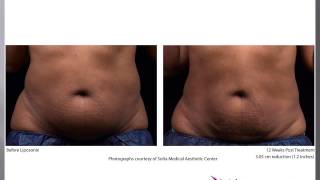 Liposonix Before amp After Photos  MBody Modern Body Contouring amp Laser Center Northern Virginia [upl. by Ateekan831]