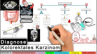 kolorektales Karzinom Ep 13 DIAGNOSE [upl. by Biddick]