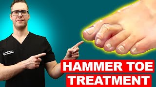 Hammer Toe Exercises Stretches amp Treatment Claw Toes amp Mallet Toes [upl. by Hoashis]