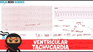 Rate and Rhythm  Ventricular Tachycardia [upl. by Aicilegna]