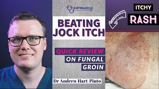 Beating Jock Itch  A Doctors Guide to Tinea Cruris  Fungal Groin Infection [upl. by Acissey]