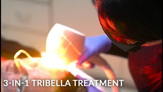 Tribella Treatment with Venus Versa  IPL AntiAging and Skin Resurfacing [upl. by Hiltner]