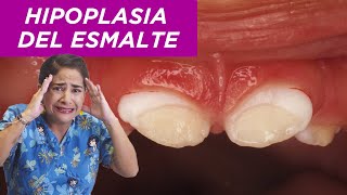 Hipoplasia del esmalte [upl. by Rosemare714]