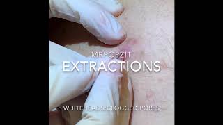 Extractionsacne surgery on back Multiple cyst pops Whiteheads [upl. by Prudi255]