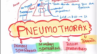 Pneumothorax Types and Treatment Respiratory 46  First Aid USMLE Step 1 in UrduHindi [upl. by Nicolle294]