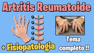 ARTRITIS REUMATOIDE  sintomas tratamiento  FISIOPATOLOGIA [upl. by Dumah271]