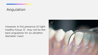 Optimize Your Cavitron Technology Cavitron® Thinsert® Insert [upl. by Naujad]