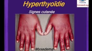 Hyperthyroidie Maladie de Basedow symptomes Endocrinologie Pathologie de la ThyroÃ¯de Cours medecine [upl. by Nertie578]